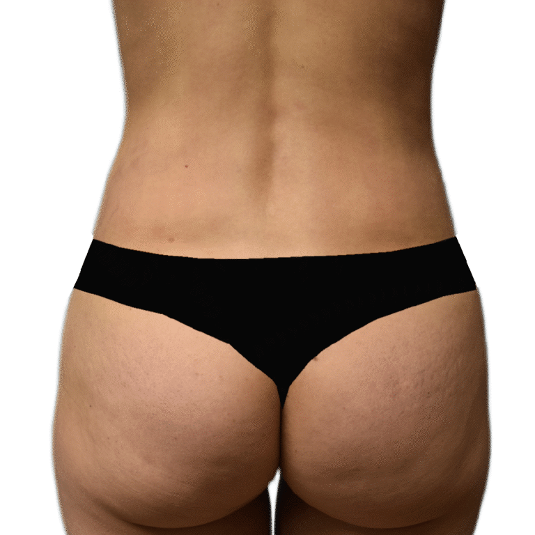 After Image: BBL - back