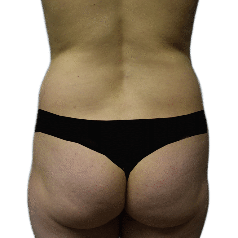 Before Image: BBL - back