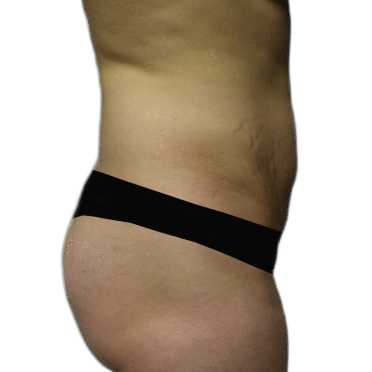 Before Image: BBL - right-side