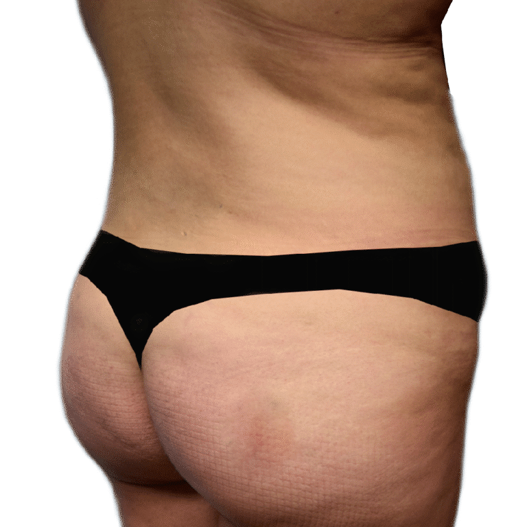 After Image: BBL - right-back-oblique