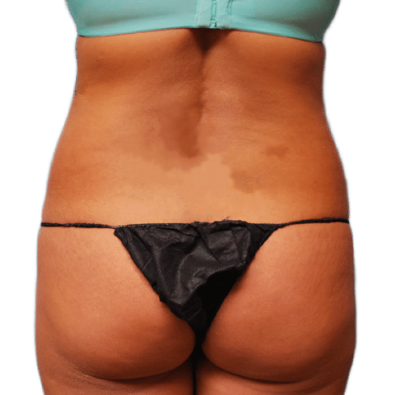 Before Image: BBL - back