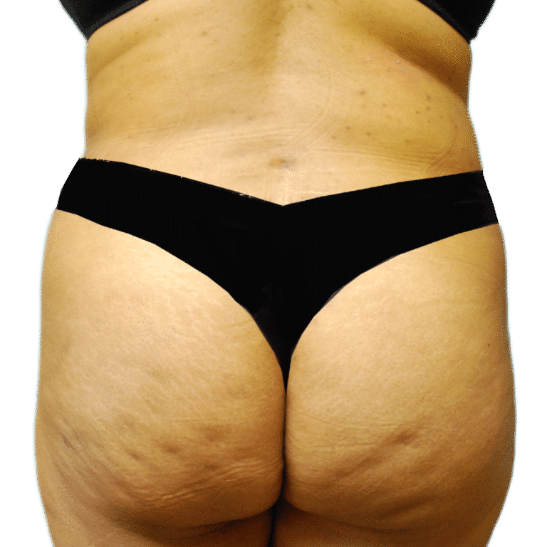 After Image: BBL - back
