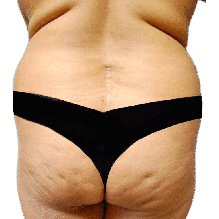 Before Image: BBL - back
