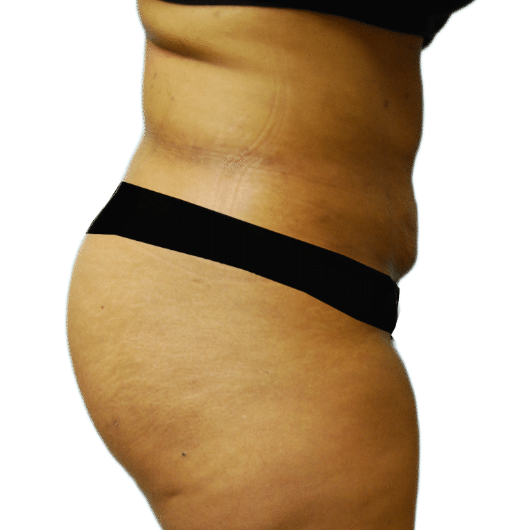 After Image: BBL - right-side