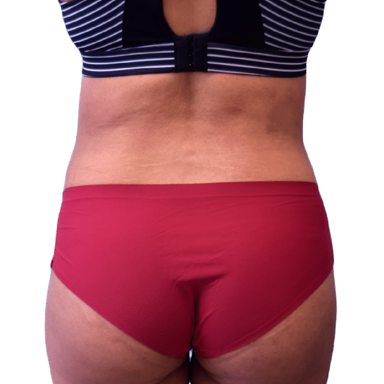 After Image: BBL - back