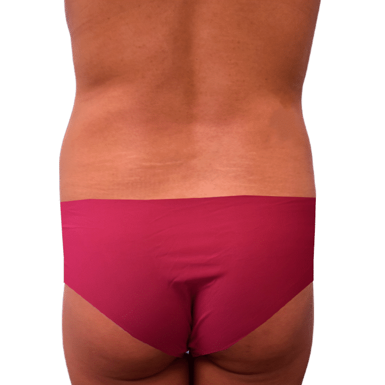 Before Image: BBL - back