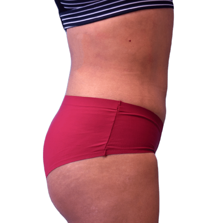 After Image: BBL - right-side