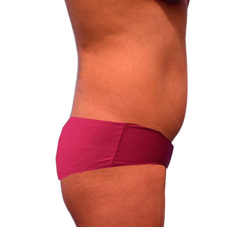 Before Image: BBL - right-side