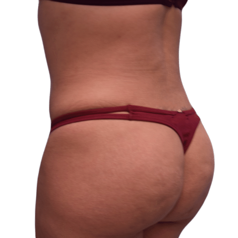 After Image: BBL - left-back-oblique