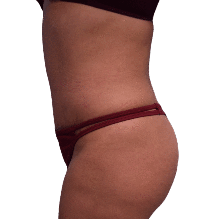 After Image: BBL - left-side