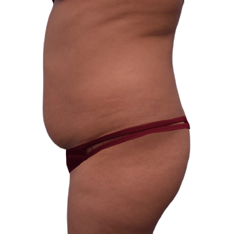 Before Image: BBL - left-side