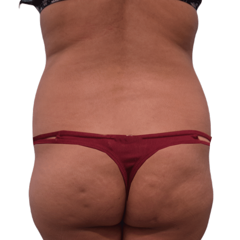 Before Image: BBL - back