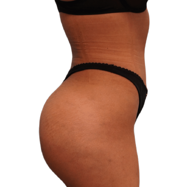 After Image: BBL - right-side