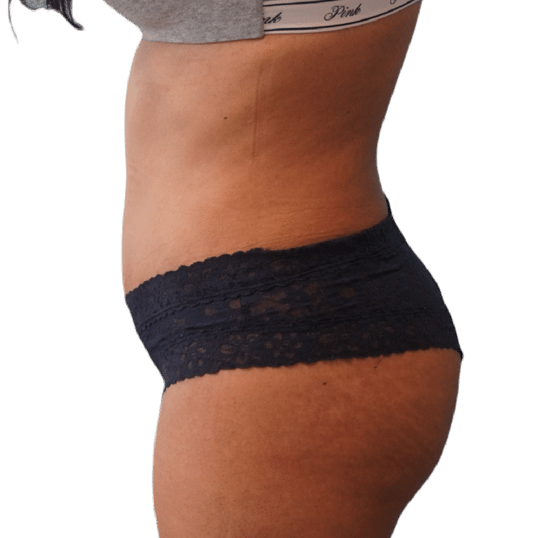 After Image: BBL - left-side