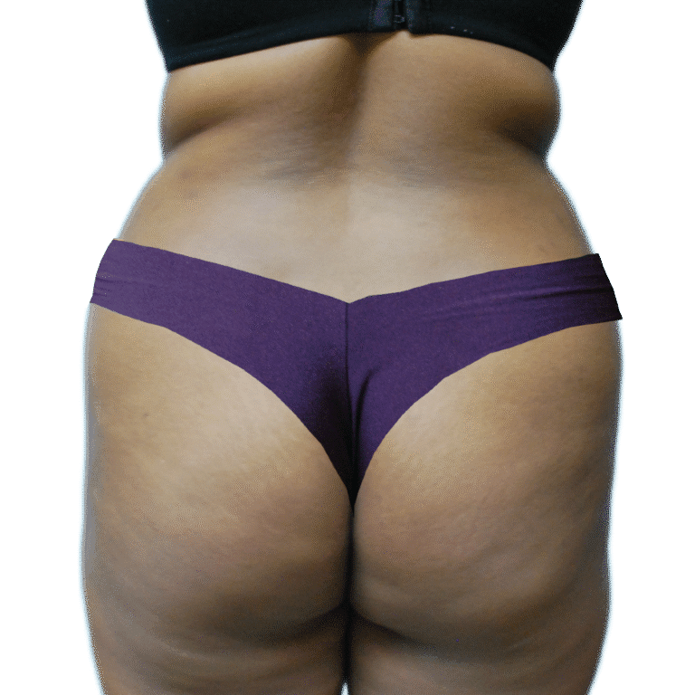 Before Image: BBL - back
