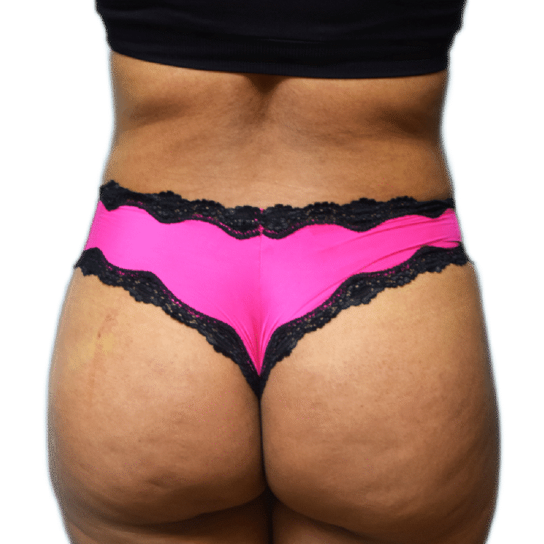 After Image: BBL - back