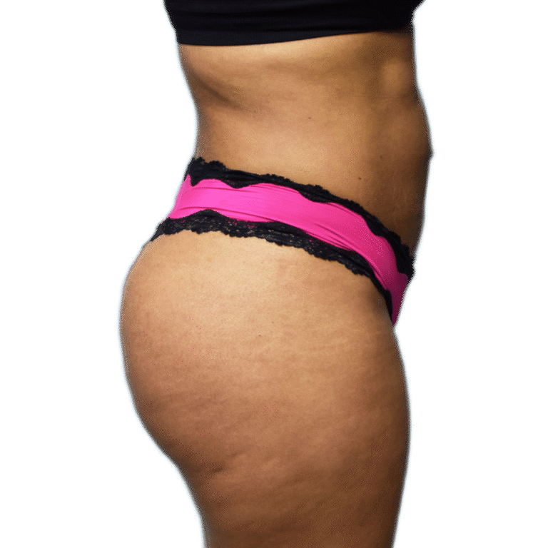 After Image: BBL - right-side