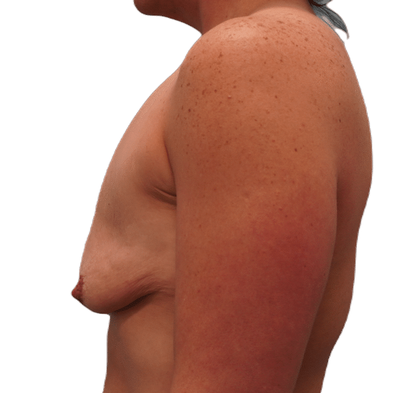 Before Image: Breast Augmentation & Lift -