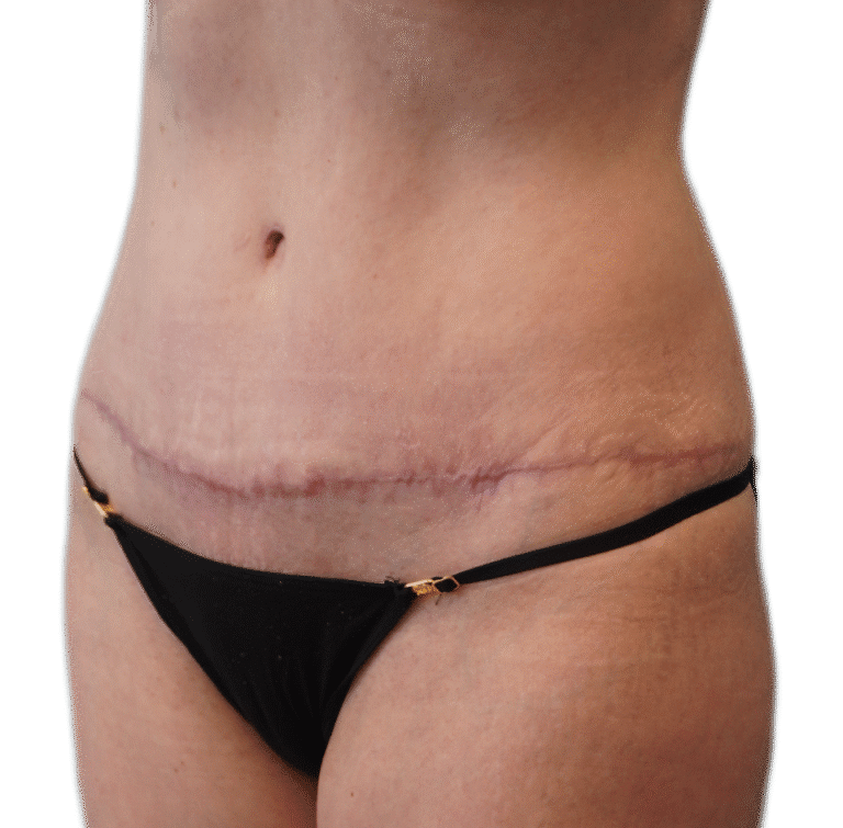 After Image: Tummy Tuck -