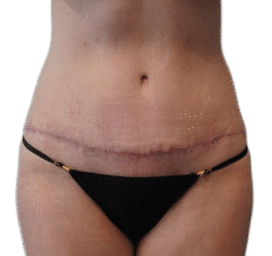 After Image: Tummy Tuck