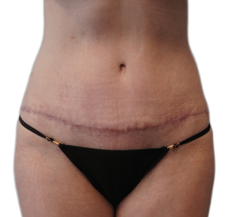 After Image: Tummy Tuck - front