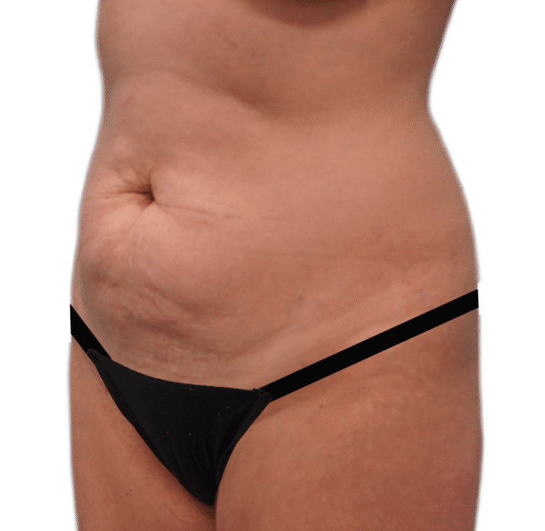 Before Image: Tummy Tuck -
