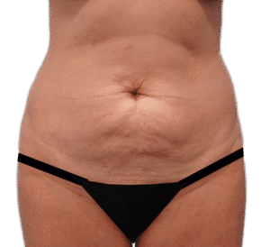 Before Image: Tummy Tuck