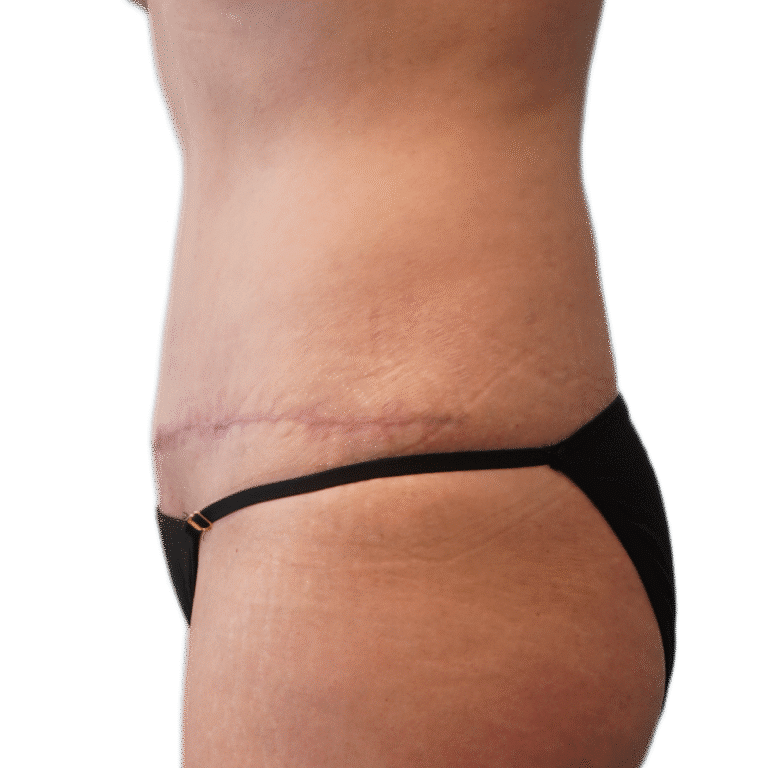 After Image: Tummy Tuck -