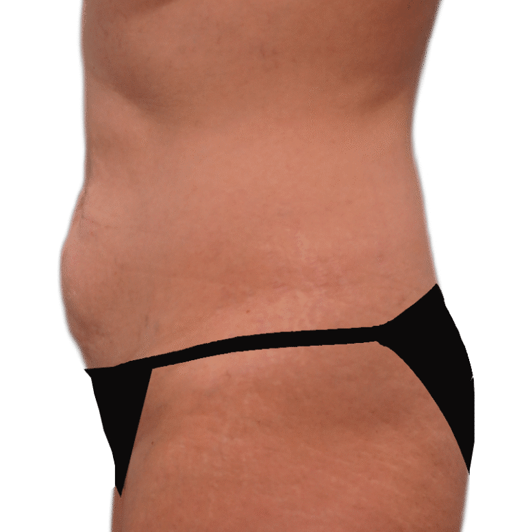 Before Image: Tummy Tuck -