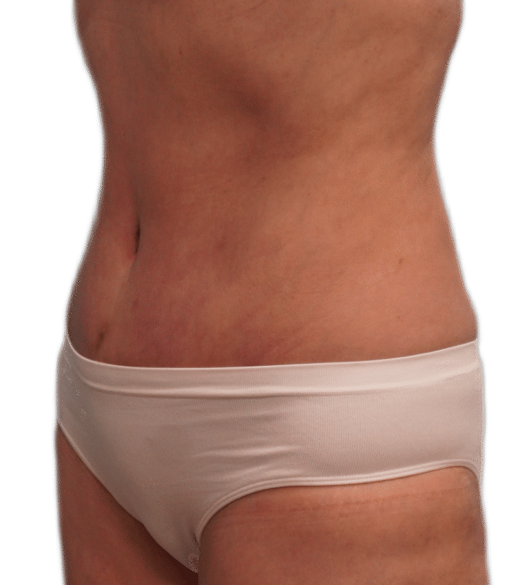 After Image: Tummy Tuck - left-front-oblique