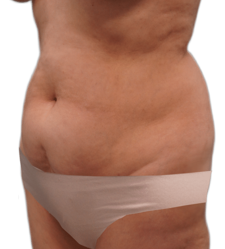 Before Image: Tummy Tuck - left-front-oblique