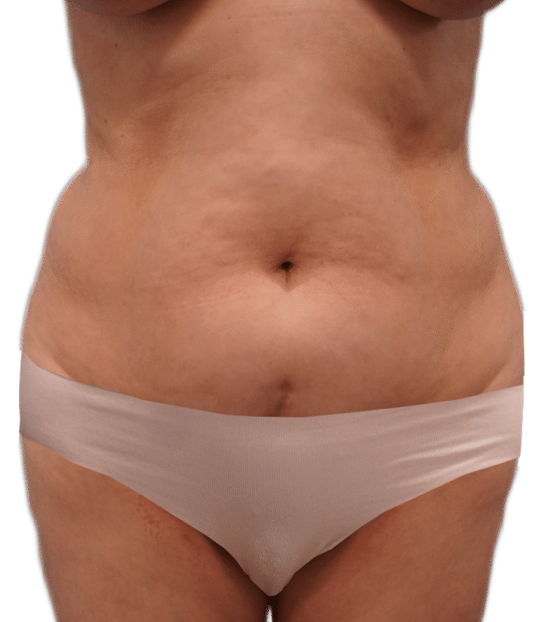 Before Image: Tummy Tuck - front