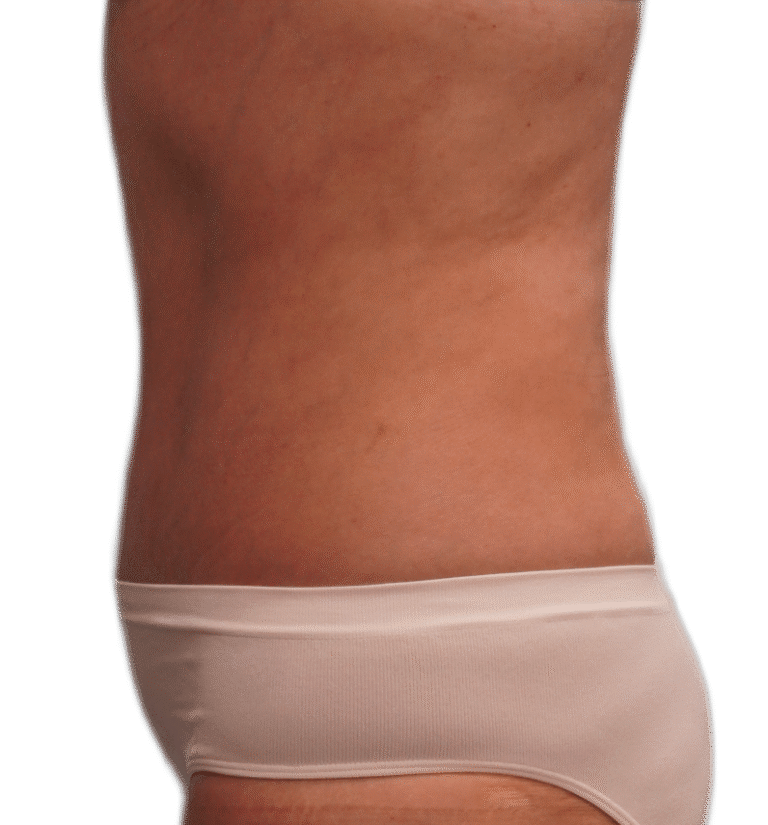 After Image: Tummy Tuck - left-side