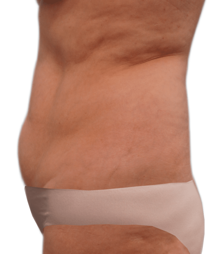Before Image: Tummy Tuck - left-side