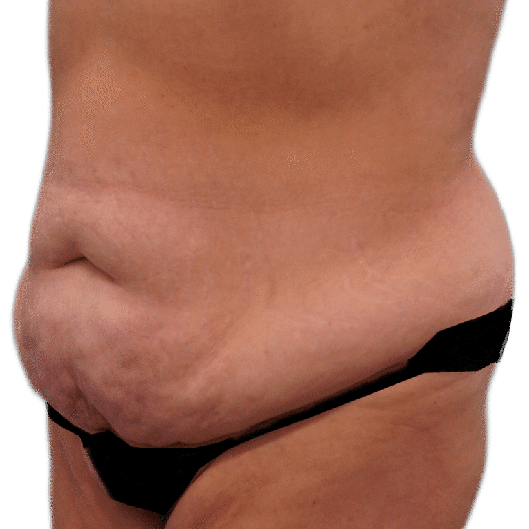 Before Image: Tummy Tuck - left-front-oblique