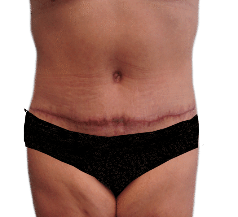After Image: Tummy Tuck - front
