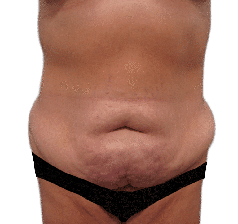 Before Image: Tummy Tuck - front