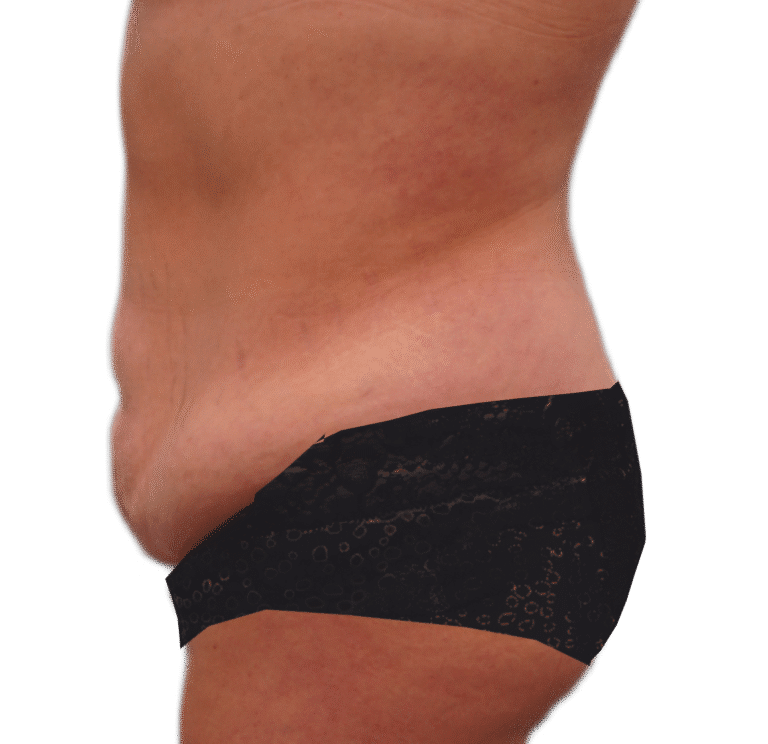 Before Image: Tummy Tuck - left-side