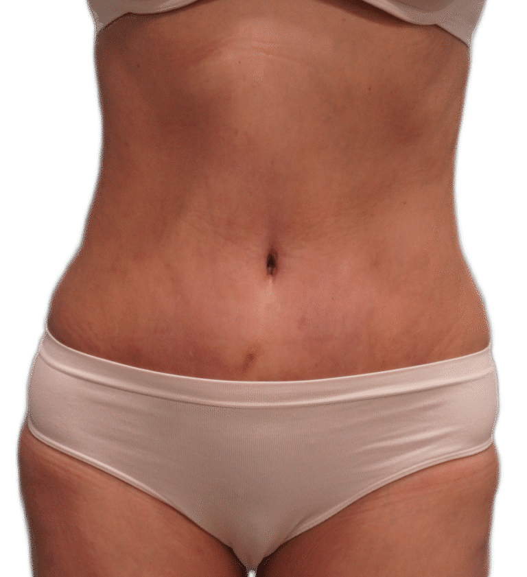 After Image: Tummy Tuck - front