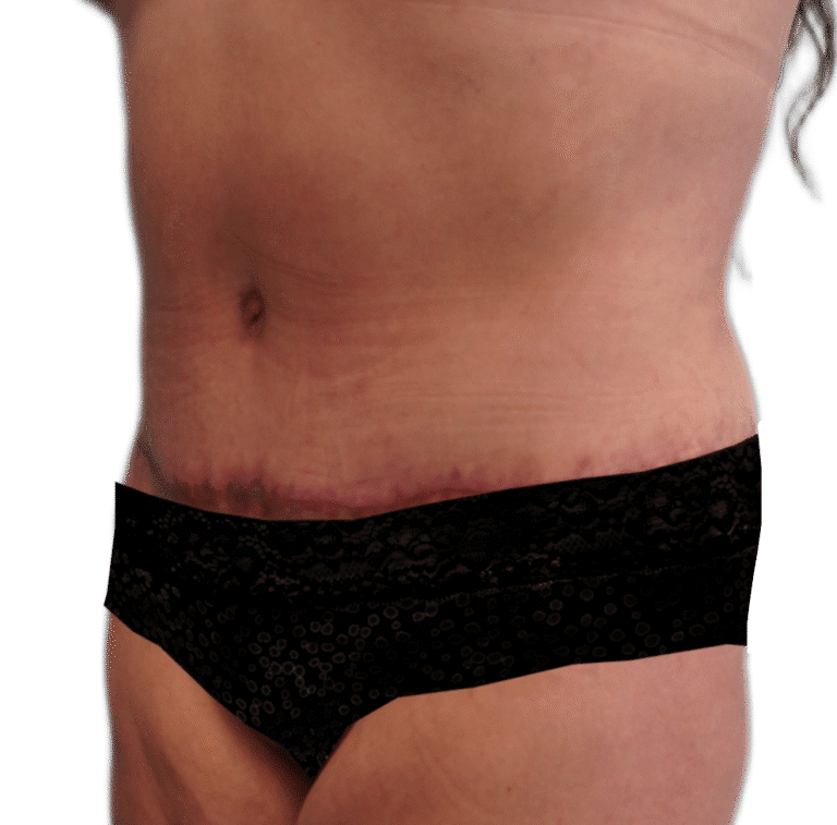 After Image: Tummy Tuck - left-front-oblique