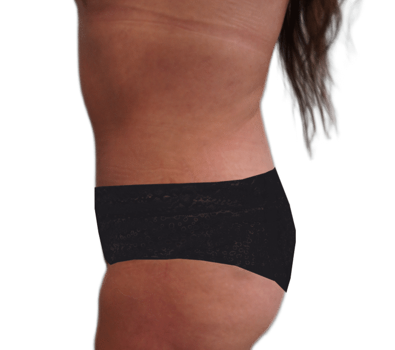 After Image: Tummy Tuck - left-side