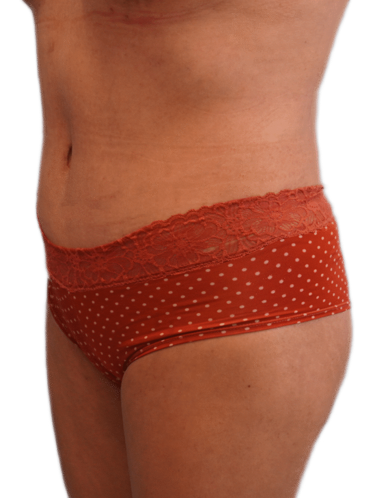 After Image: Tummy Tuck - left-front-oblique