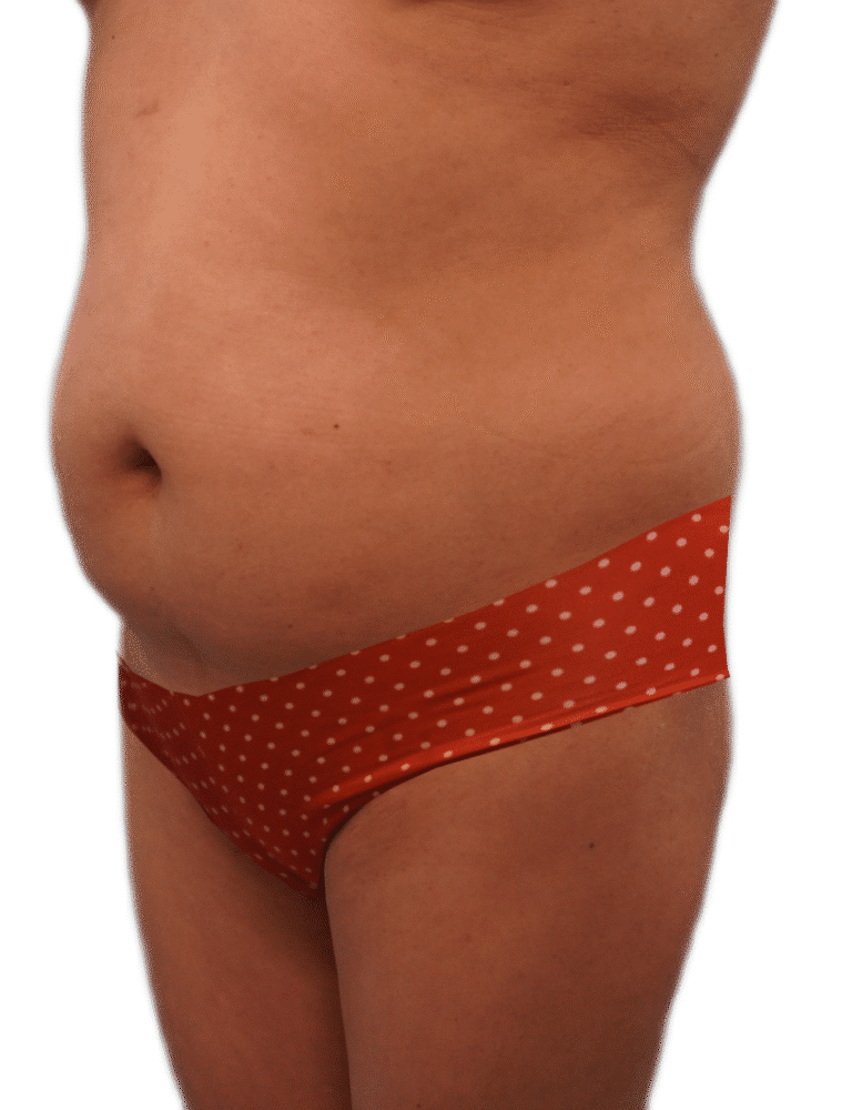 Before Image: Tummy Tuck - left-front-oblique