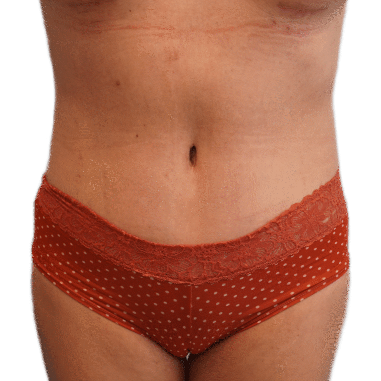 After Image: Tummy Tuck - front
