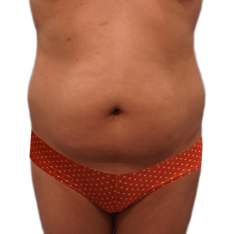 Before Image: Tummy Tuck - front