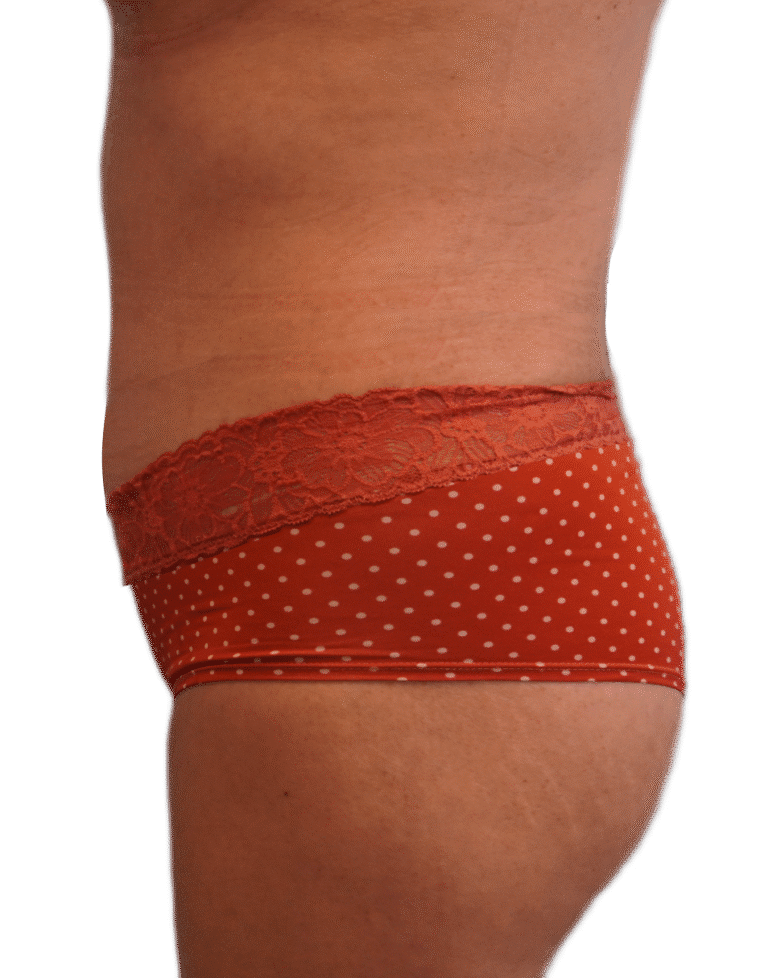 After Image: Tummy Tuck - left-side