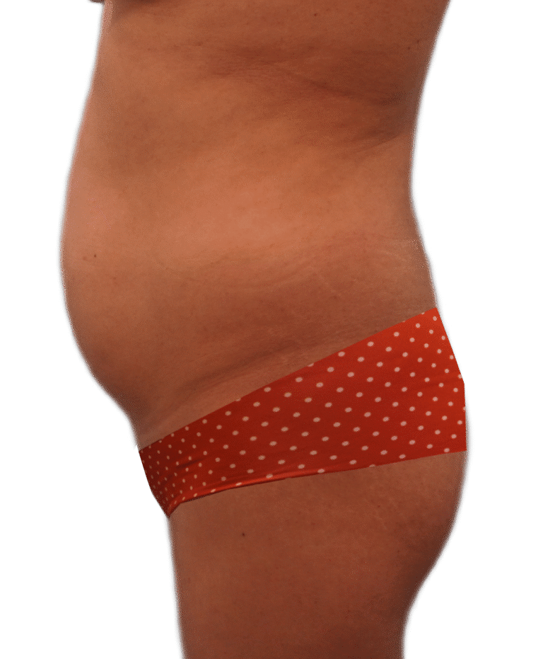 Before Image: Tummy Tuck - left-side