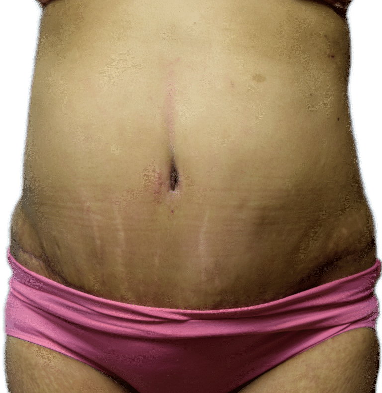 After Image:  - front