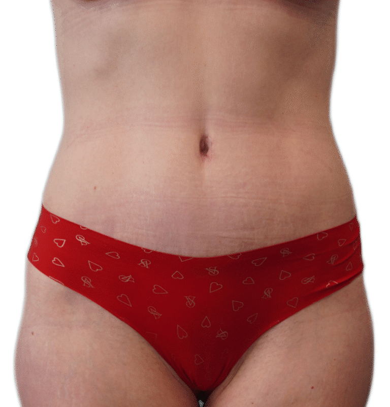 After Image: Tummy Tuck - front