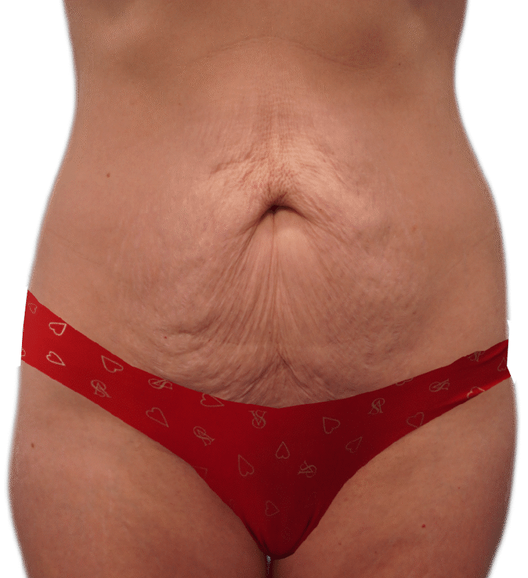 Before Image: Tummy Tuck - front